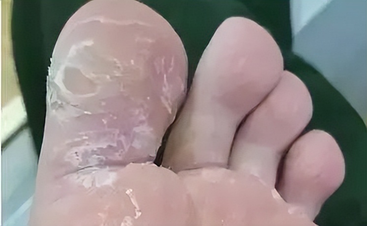 真菌清热除湿的口服中成药,细菌性皮肤病的常用药