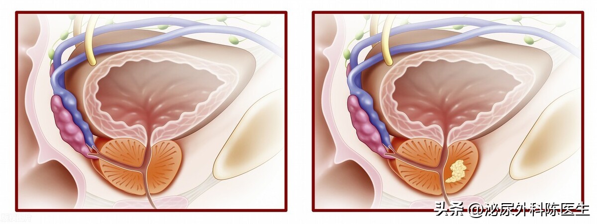 治疗前列腺钙化常用药,前列腺肥大钙化的治疗
