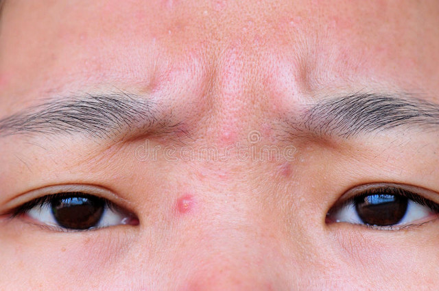 碘伏正品医用,碘伏祛痘痘效果怎么样