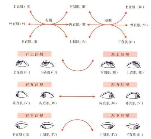 糖尿病麻痹性斜视如何治疗,斜视引起的脖子歪