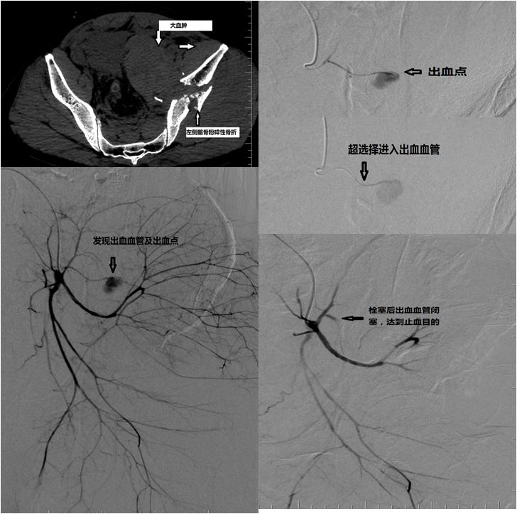 骨盆粉碎性骨折大出血怎么止血,骨盆骨折介入急救流程