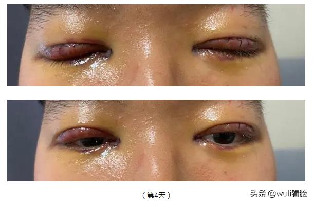 男生割双眼皮的意思,男生眼睛小割双眼皮会好看吗