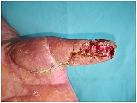 手指被牙签扎了没流血有脓液,手指被扎了一下没有破但是有红点