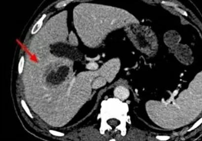 肝内血管瘤和肝癌超声怎么区分,肝占位病理检测项目