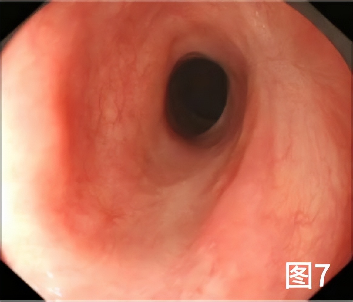 病例档案纪录片,食管早期癌的内镜筛查