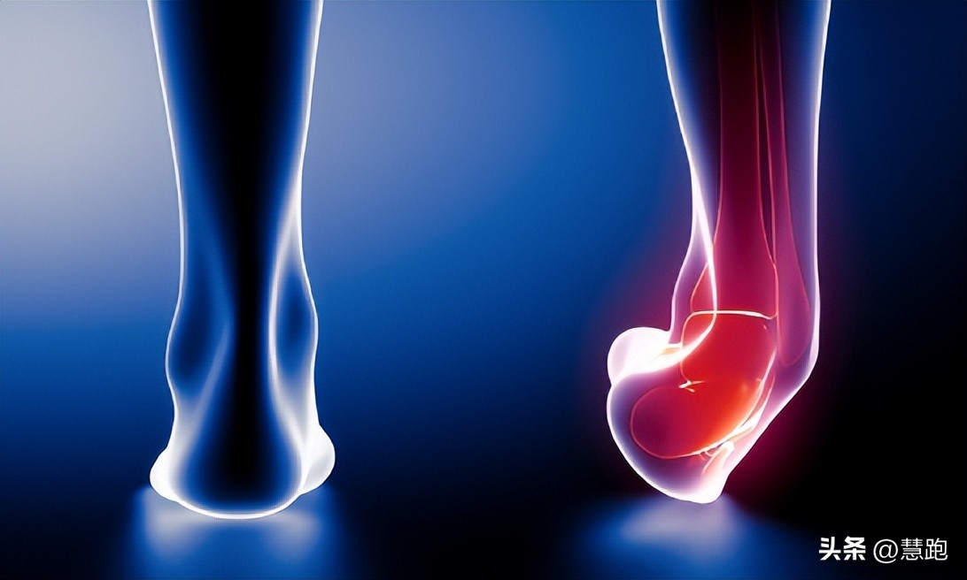 这类顽固性的跑步伤痛最让跑者头疼：4种有效康复方法教你破解