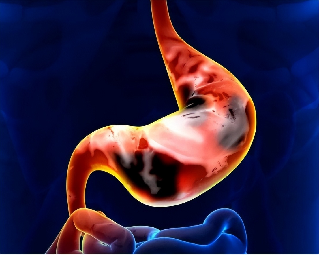 日本胃癌患病率为什么那么高,中国和西方国家患癌比例