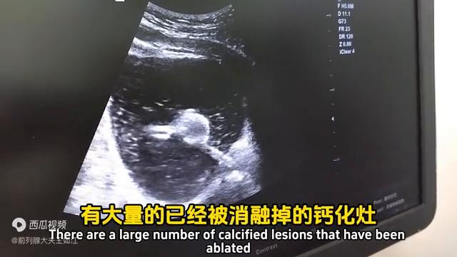 孔医生治疗前列腺炎,经尿道前列腺消融治疗步骤