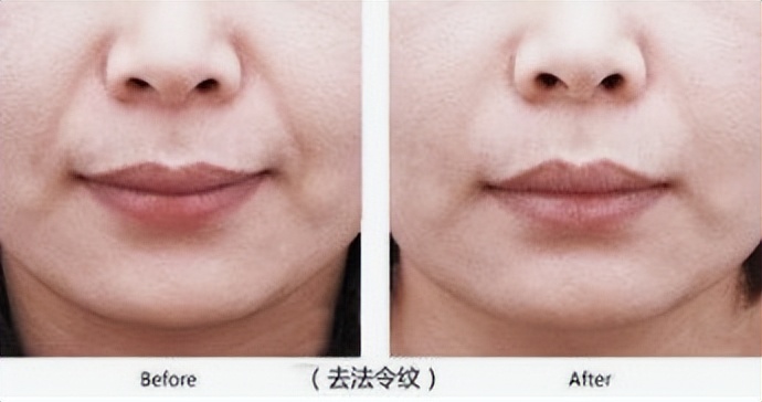 法令纹怎么治疗最快,怎么判断自己的法令纹什么类型