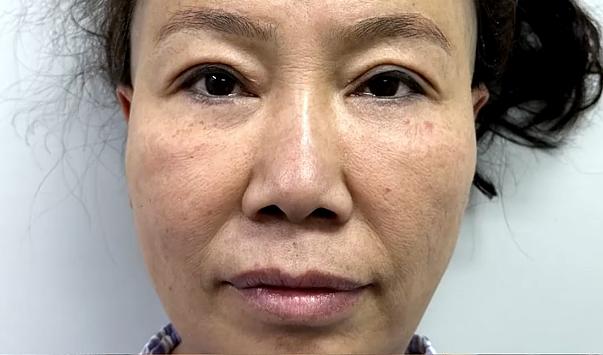 大拉皮手术34岁适合做吗,56岁面部拉皮术后效果