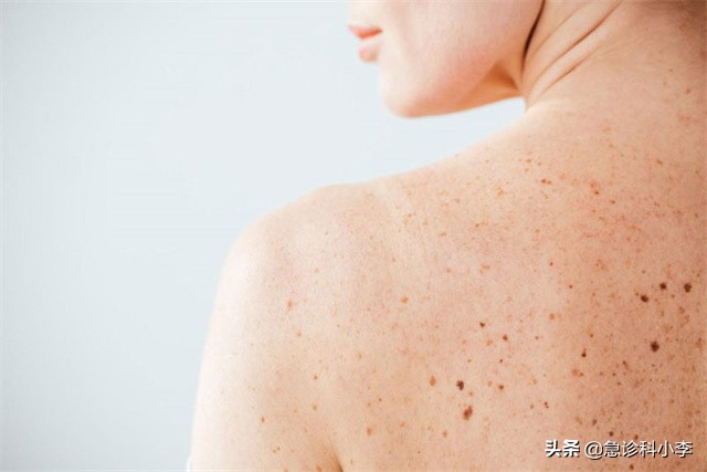 孩子身上小红点不痛不痒是什么病,身上起小红点不痛不痒按压会消失