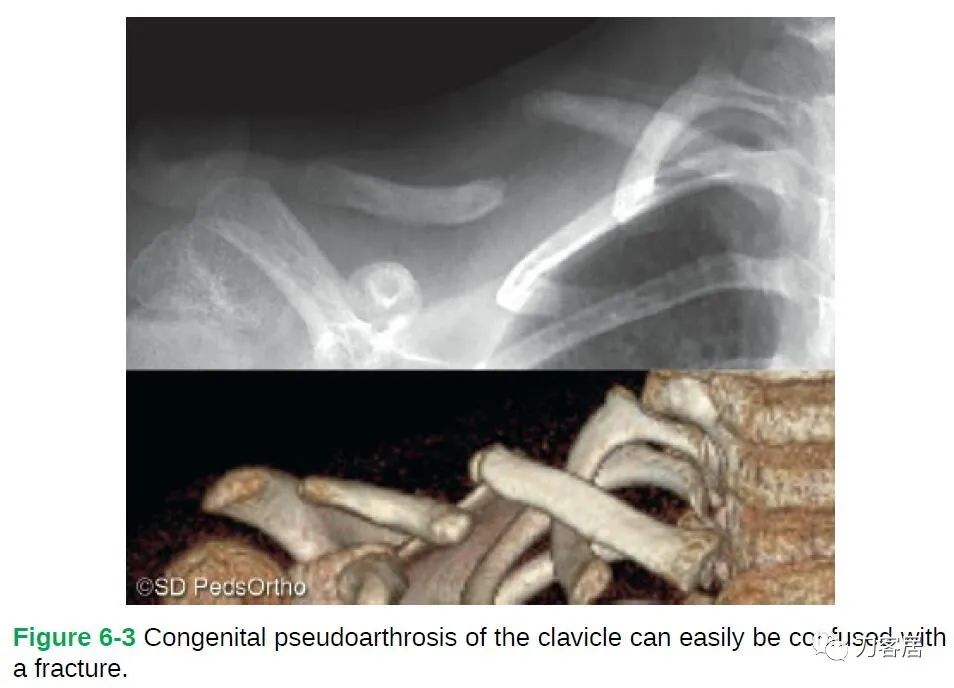 儿童锁骨骨折保守治疗的弊端,锁骨粉碎骨折错位不处理会愈合吗