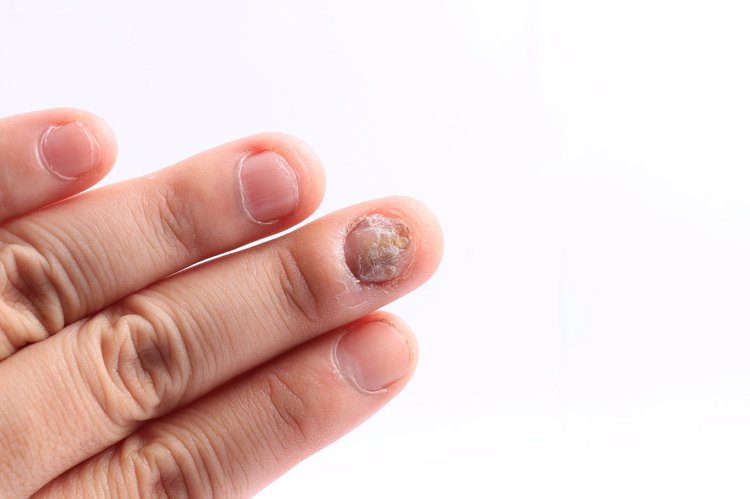 指甲提示疾病图片加介绍,指甲出现哪4种情况是癌症的征兆