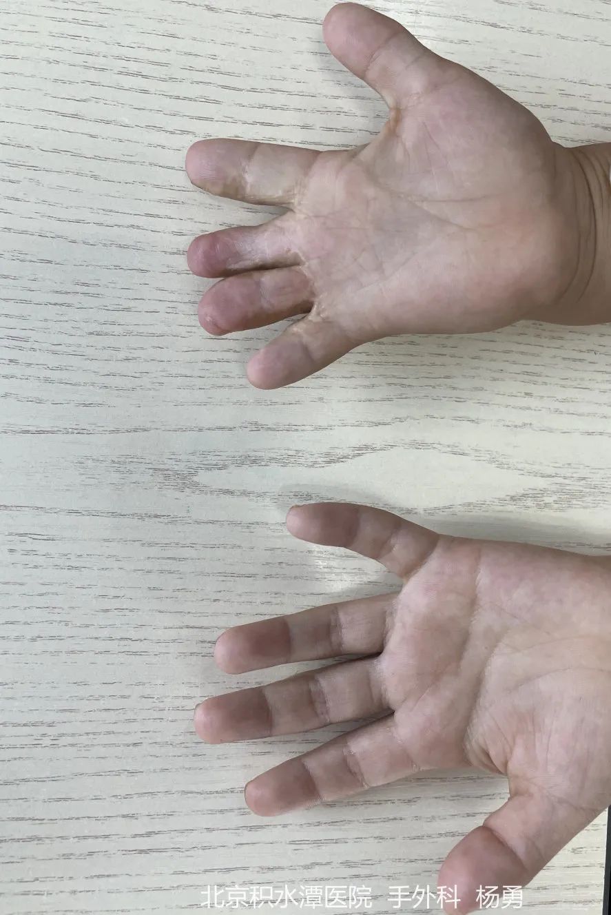 并指畸形手术最佳时机,并指畸形