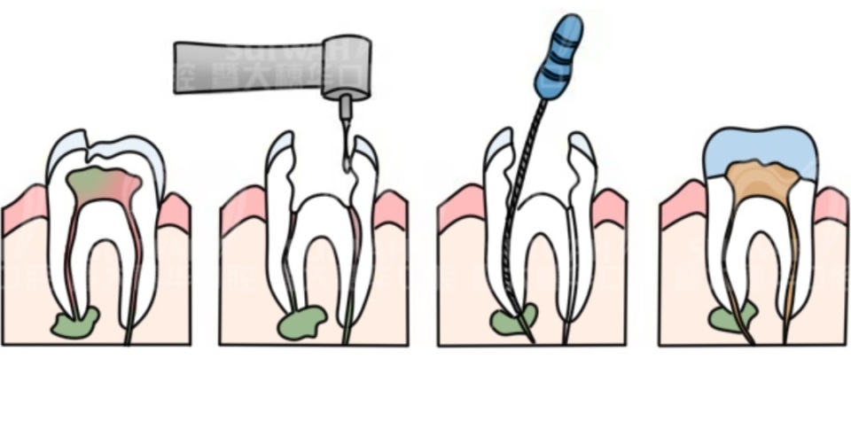 根管治疗为什么只要400块,有多少人接受过根管治疗
