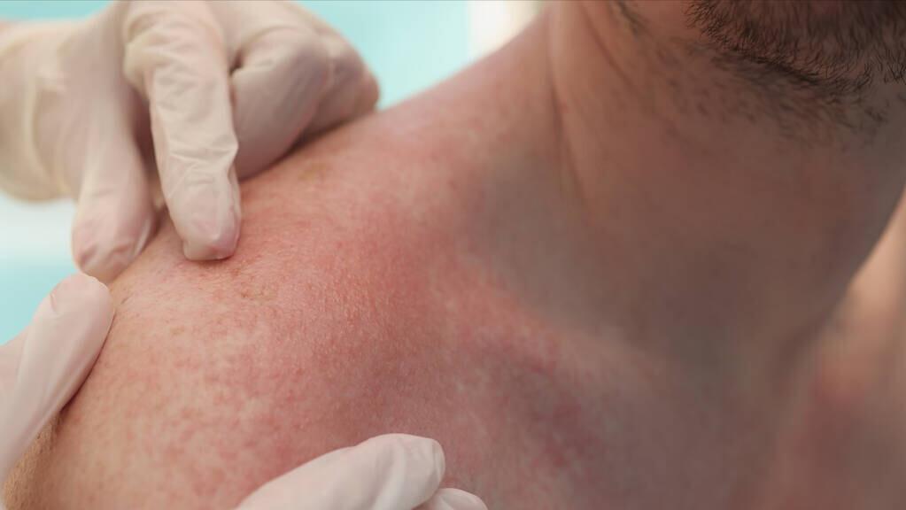 过敏原是怎么引起过敏的,过敏危害的分析