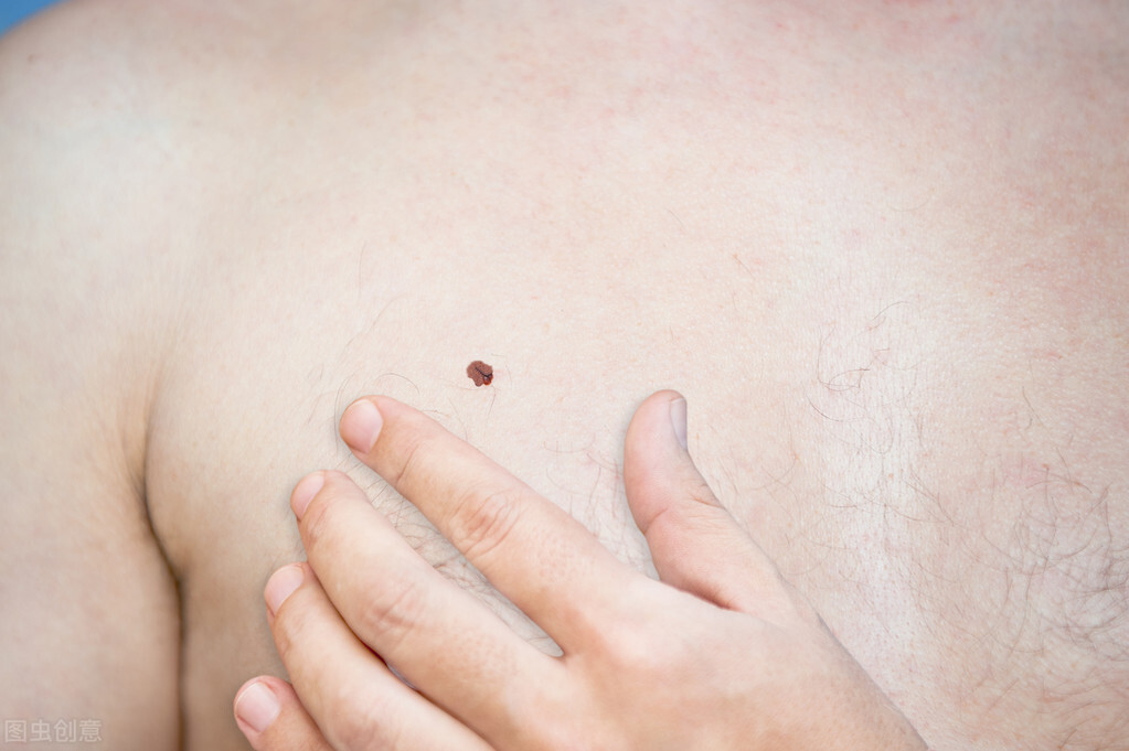 如何分辨脸上的凸痣是良性或恶性,如何来辨别良性痣和恶性痣