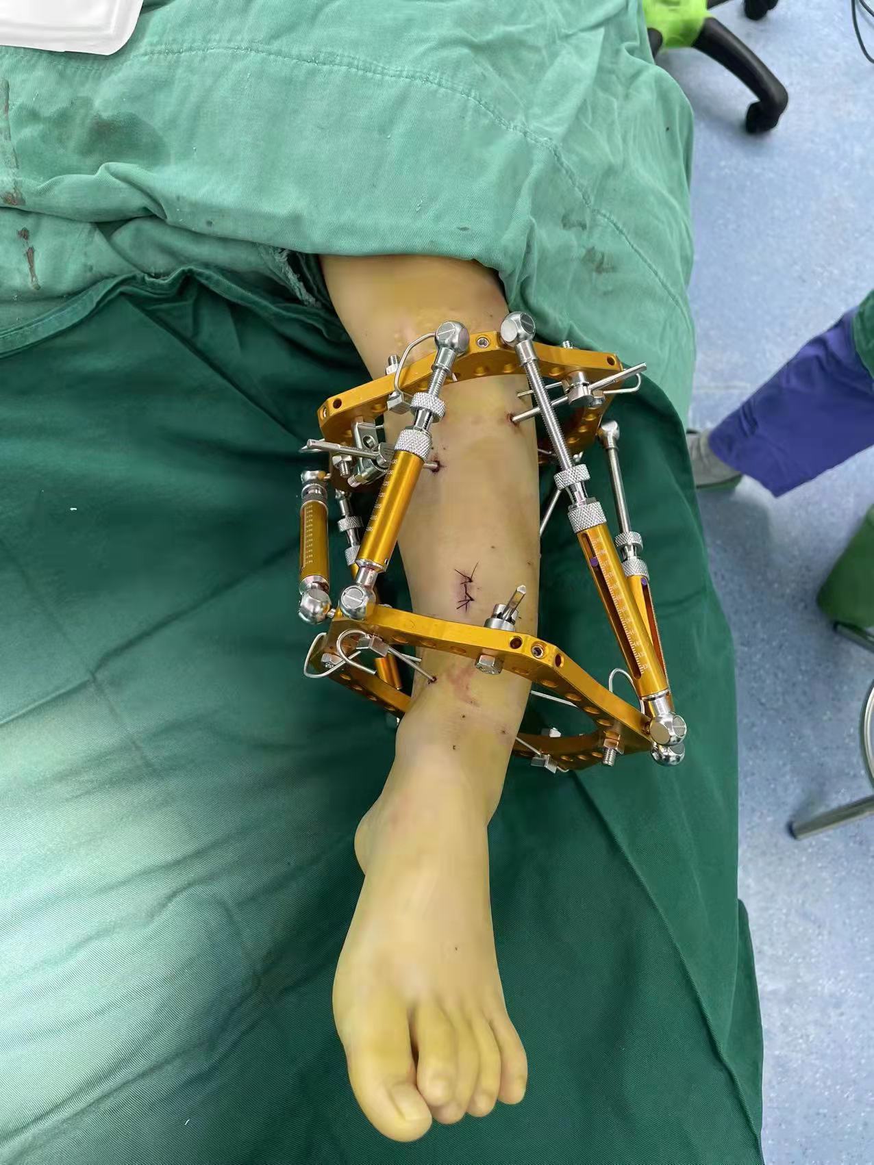 小儿骨科足内翻手术,双足内翻畸形手术