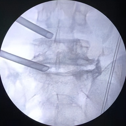 门医技术|门头沟区医院骨二科成功应用微创椎间孔镜技术治疗两例腰椎管多节段狭窄症