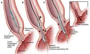 胃食管反流咽喉炎治疗方法,ppi治疗胃食管反流疗程