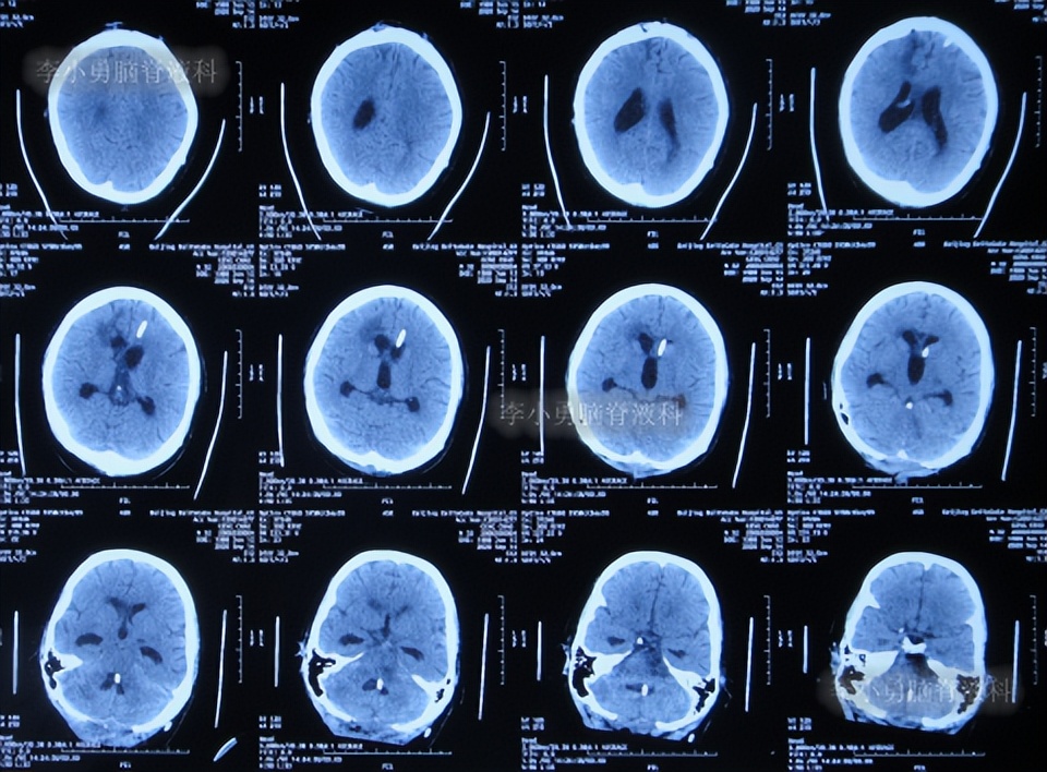 脑积水三脑室造瘘多久能恢复,脑囊虫手术后脑积水