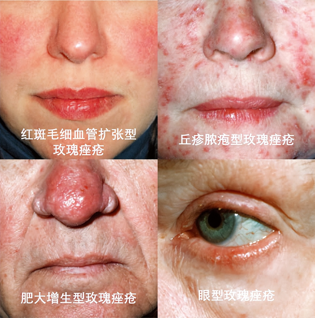 名医面对面丨夏立君：经常熬夜、酗酒，当心“玫瑰*疮痤**”！