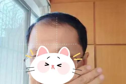 白头发不染可以戴假发吗,假发可以解决白头发的烦恼