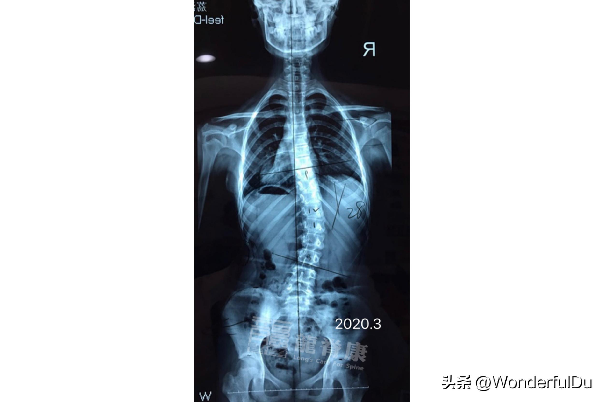 儿童脊柱侧弯导致长短脚怎样矫正,脊柱侧弯引起的长短脚能治愈吗