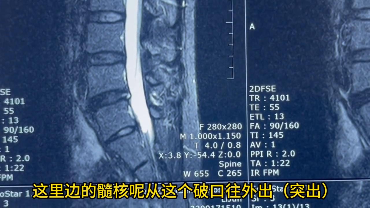 盘源性腰痛的治疗方法,盘源性腰痛的症状与治疗方法