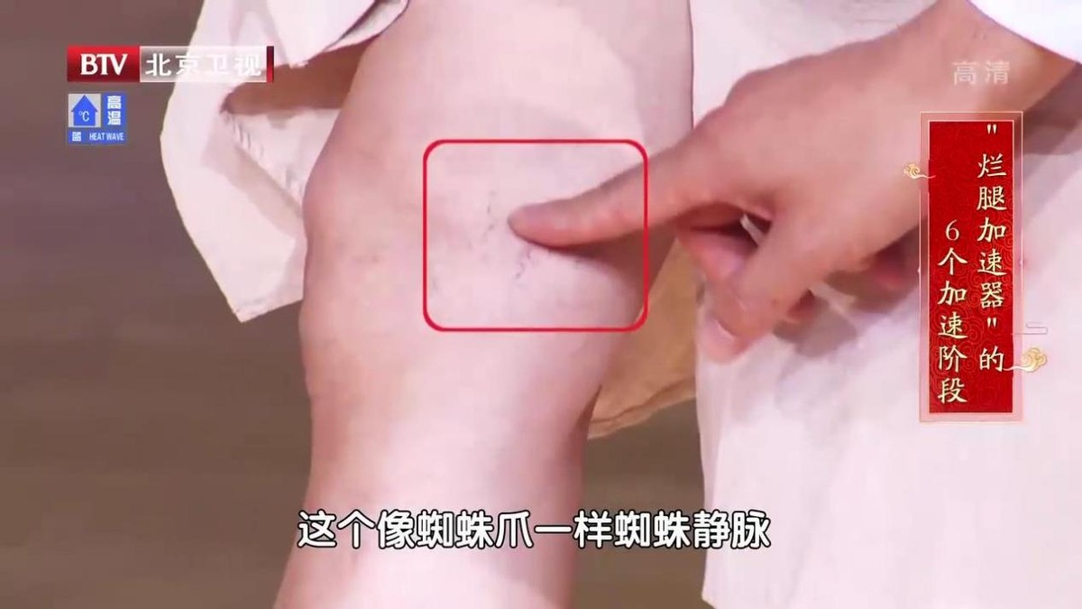 腿酸胀难受怎么缓解静脉曲张,单腿小腿酸胀发麻是静脉曲张吗