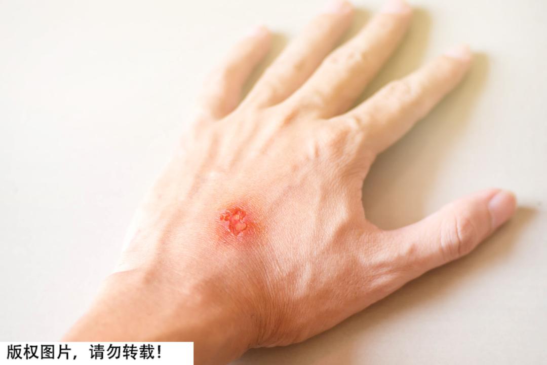 结痂为什么感觉很紧绷,结痂很痒可以抠掉吗