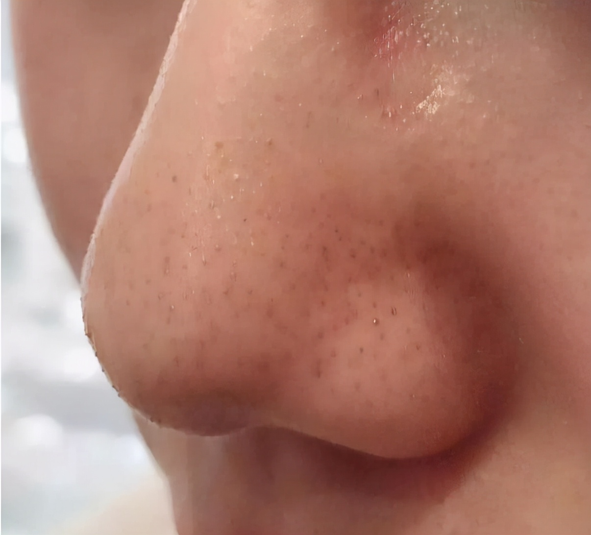 鼻子上挤出来的白色条是什么,鼻子里有白色条状粘稠物