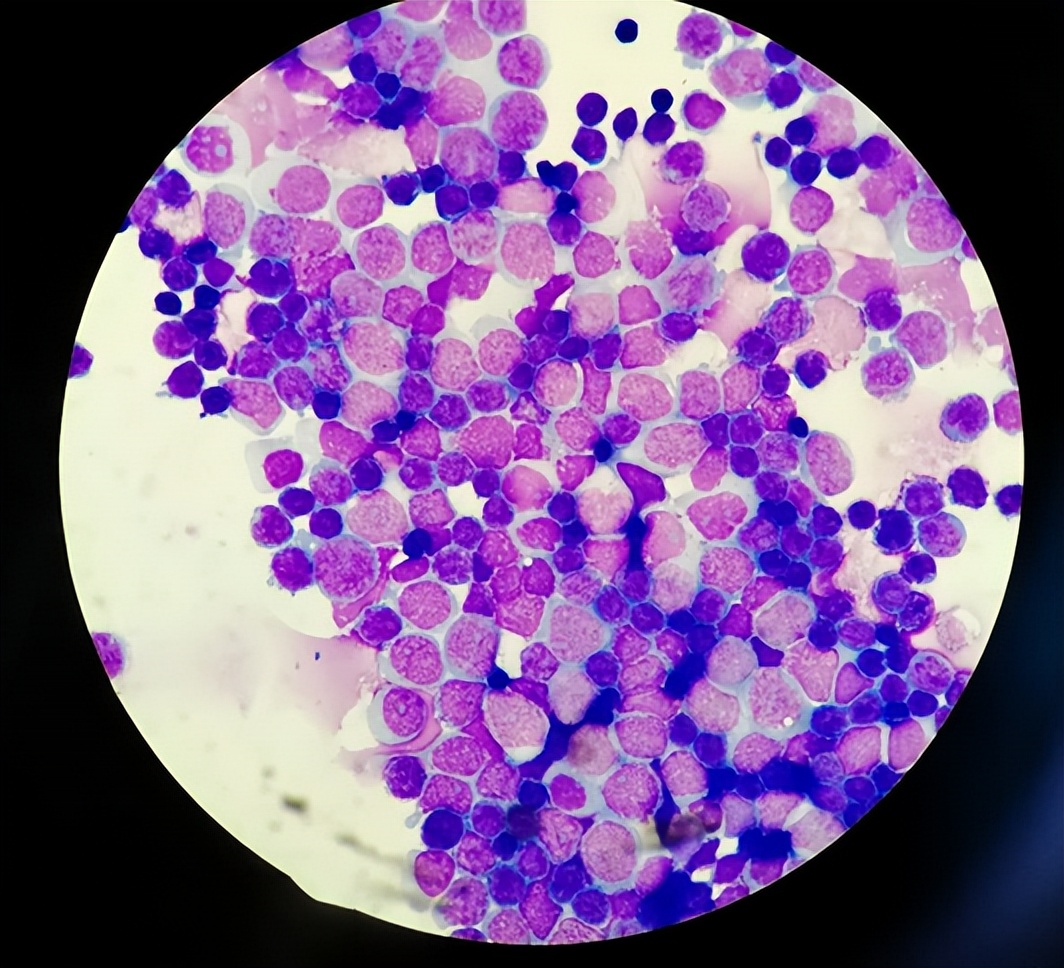 脑膜炎10天才确诊,脑膜炎确诊