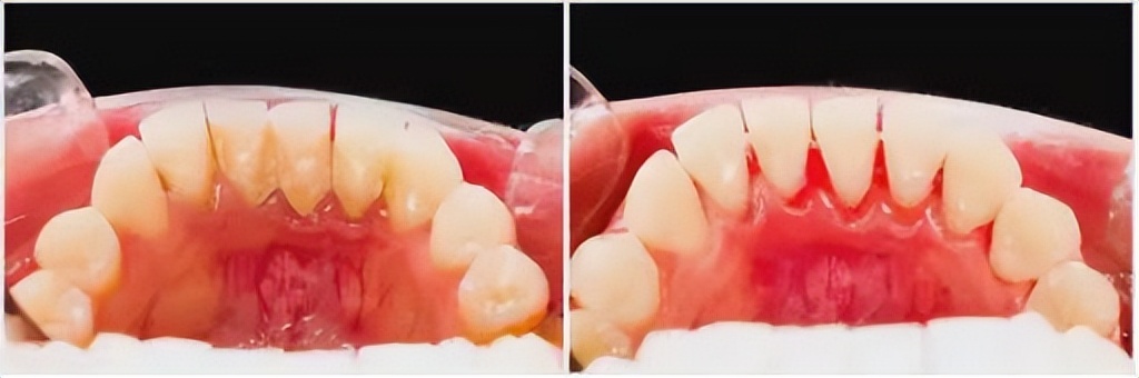 漱口水用多了能去除口臭么,漱口水对去口臭真的有用吗