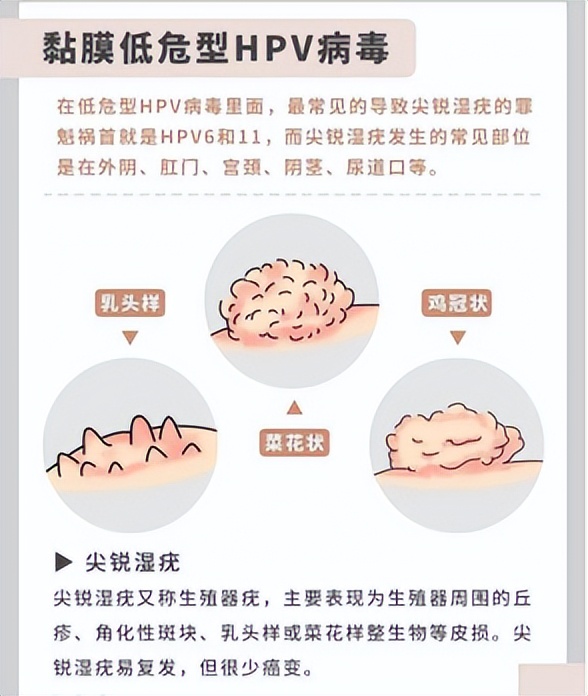 HPV不可忽视的知识点,一篇文章让你了解透彻