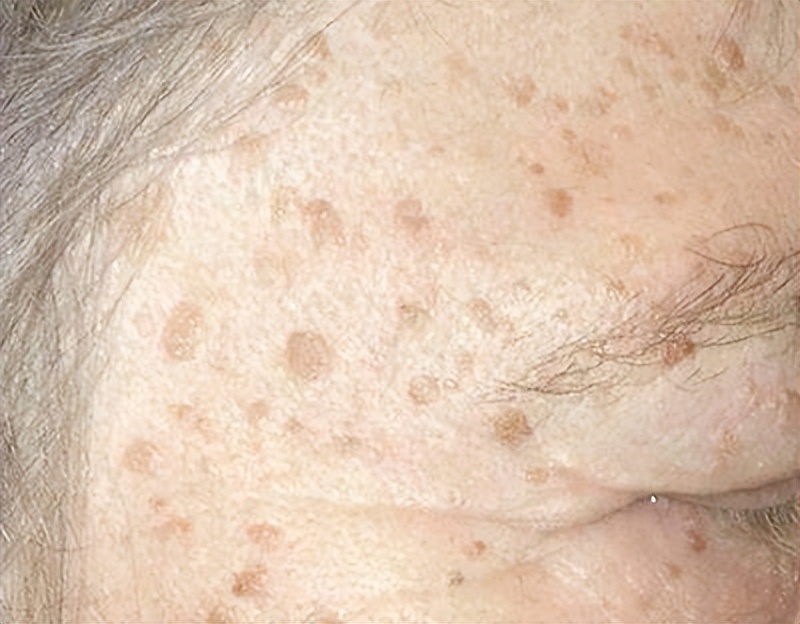 为什么有些人老年斑“密密麻麻”，有些人却没有？医生告诉你真相