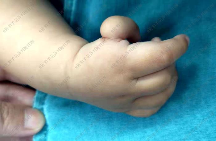 宝宝有漂浮拇指会聪明吗,漂浮拇指宝宝需要做手术吗