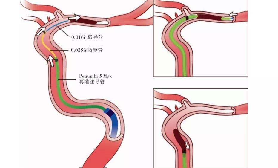 为什么吸烟能引起心梗呢,吸烟为什么会导致心梗