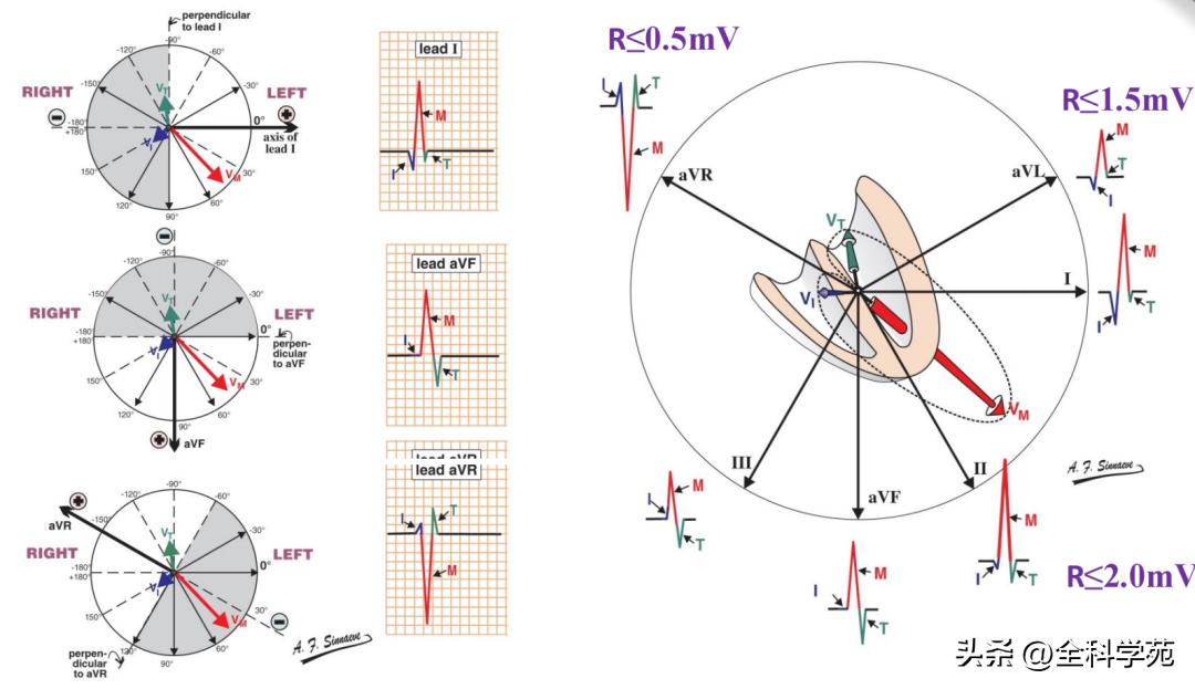 心电图qrs间期变长是怎样造成的,心电图qrs振幅多少是正常范围