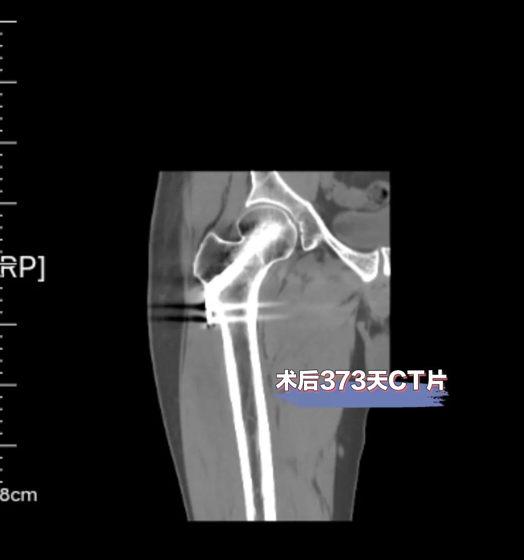 股骨颈骨折康复治疗,股骨颈骨折内固定康复
