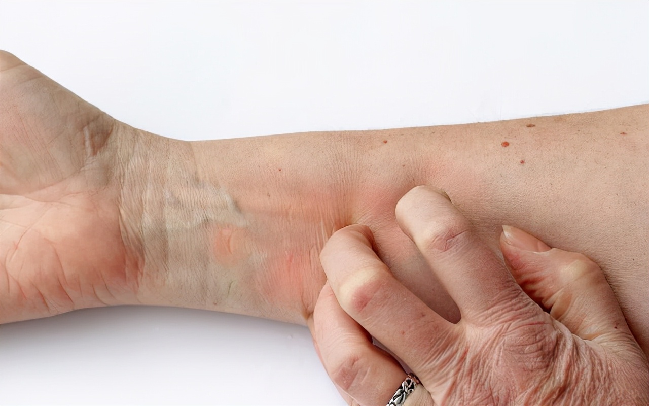 身上起红色小点点是不是hpv,身上有红色小血点跟hpv有关系吗