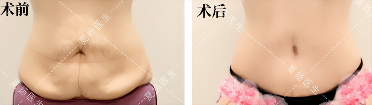 做了开腹手术怀孕了咋办,做完腹腔镜手术后发现怀孕了