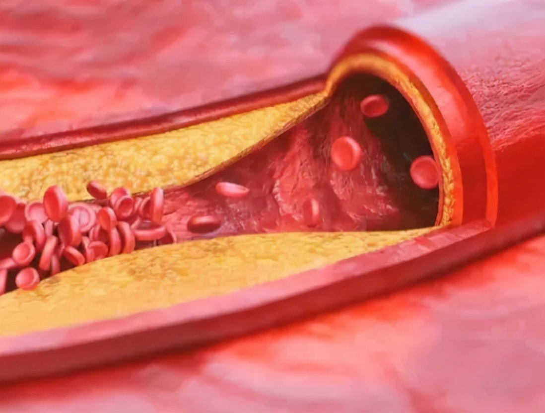 为何如此多的人发生脑梗?要怎么正确应对?一文给您详细讲清楚