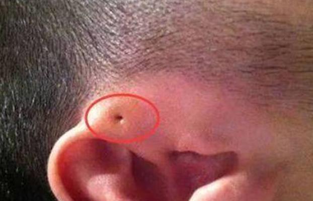 孩子耳朵有一个洞,小孩耳朵耳膜有一个小小的洞
