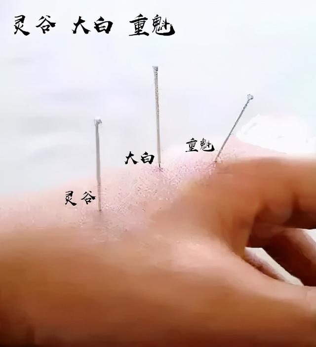 中医经络调理针灸视频,中医针灸规范处方范例