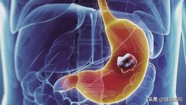 国际护胃日浅表性胃炎,胃有问题的胃镜检查全过程