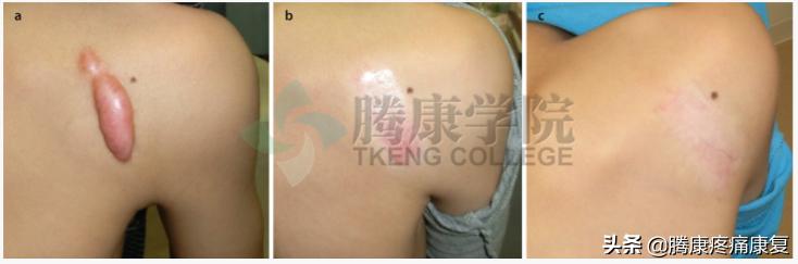 皮质类固醇贴剂治疗瘢痕疙瘩,类固醇激素治疗疤痕增生