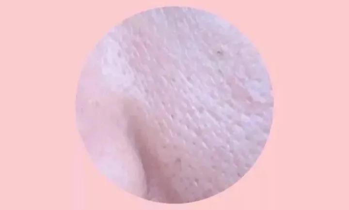 几款解决毛孔粗大的实用方法,毛孔粗大全搞定这些知识要牢记