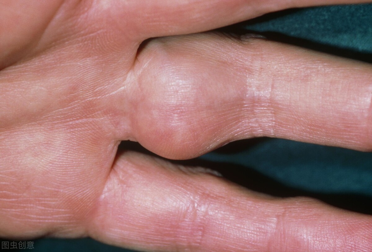 踝关节滑膜炎的症状,髋关节滑膜炎症状有哪些表现