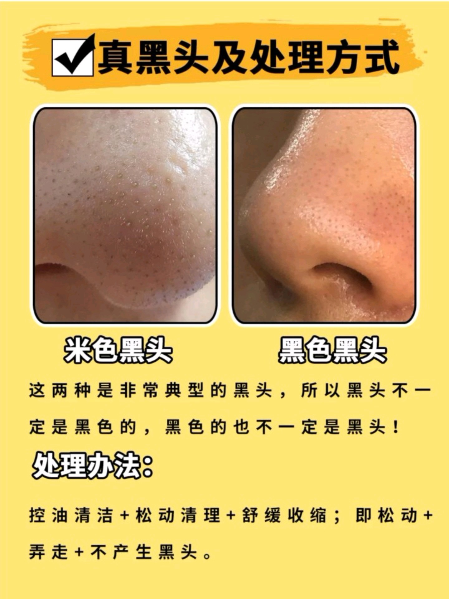 怎么去黑头好用又有效,黑头比较严重祛黑头最有效的方法